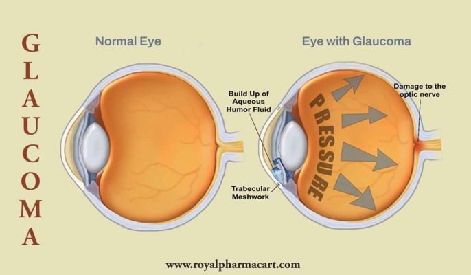 Glaucoma